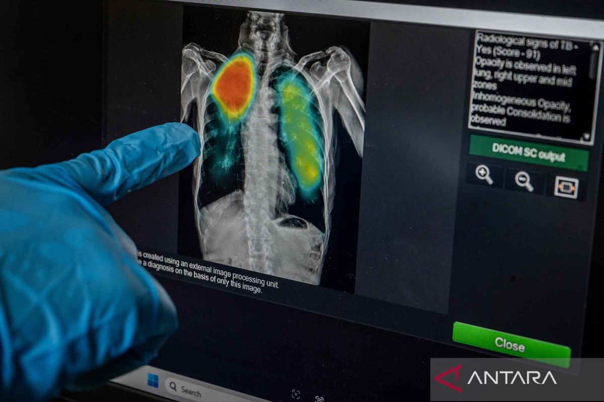 Rendahnya pengetahuan hingga stigma menjadi hambatan pengobatan TBC