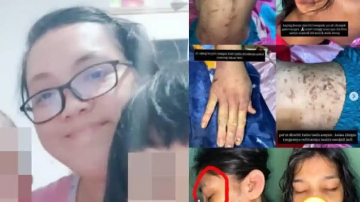 Ternyata Bukan Hanya Sekali, ART di Bogor Disiksa ASN BPK Sejak 6 Bulan Lalu